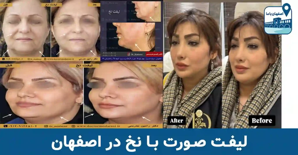 لیفت چشم گربه ای با نخ اصفهان