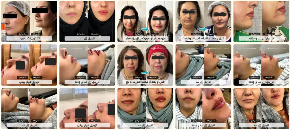 دکتر لیفت صورت با نخ در اصفهان