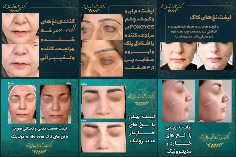 بهترین دکتر لیفت با نخ در اصفهان