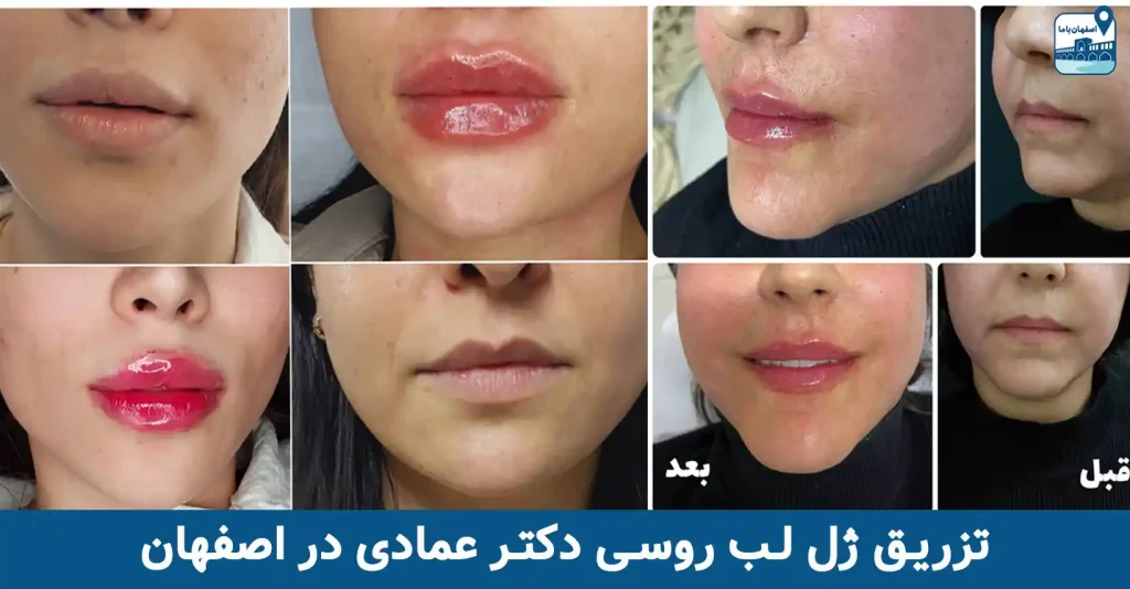 تزریق ژل لب روسی دکتر عمادی در اصفهان