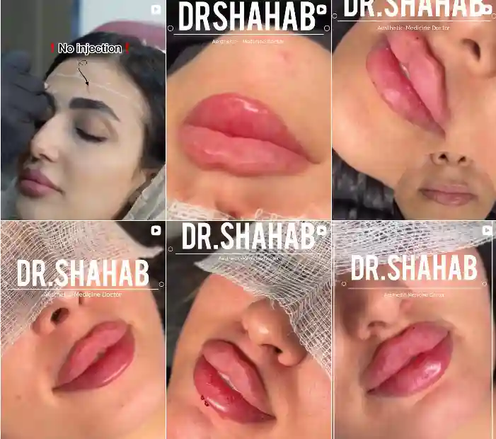 هزینه تزریق ژل لب در اصفهان