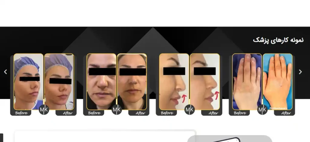 هزینه تزریق ژل لب در اصفهان