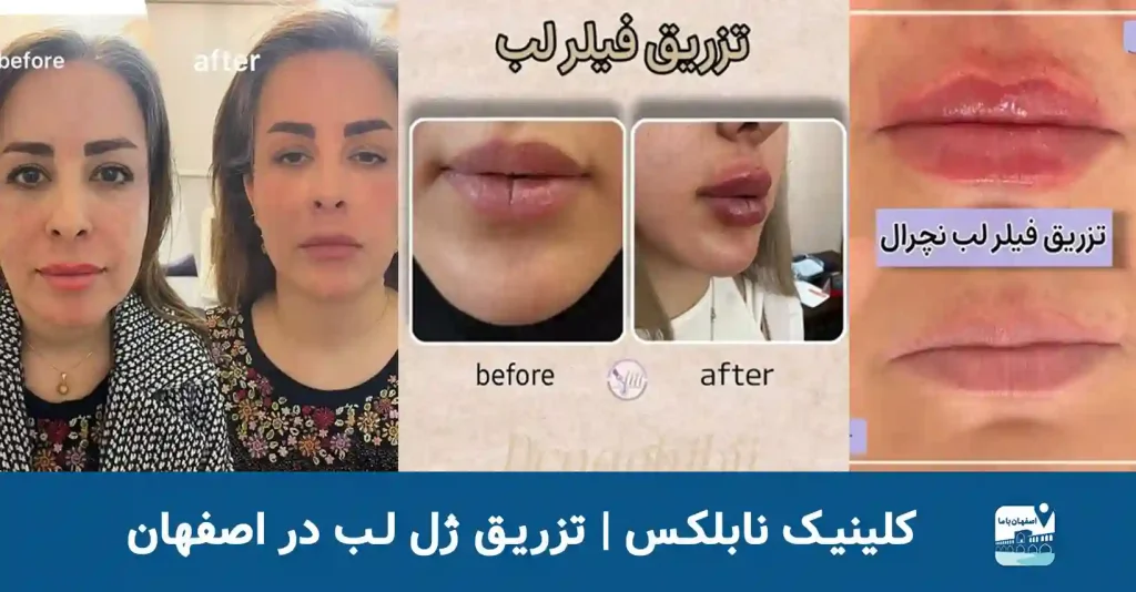 کلینیک نابلکس | تزریق ژل لب اصفهان