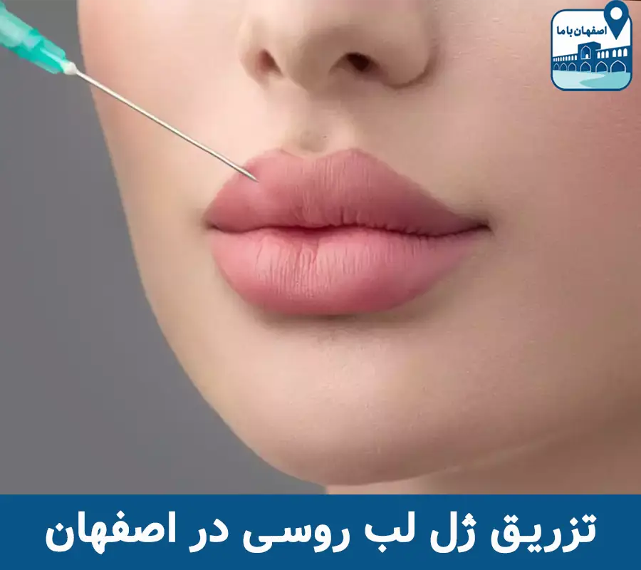 تزریق ژل لب روسی در اصفهان