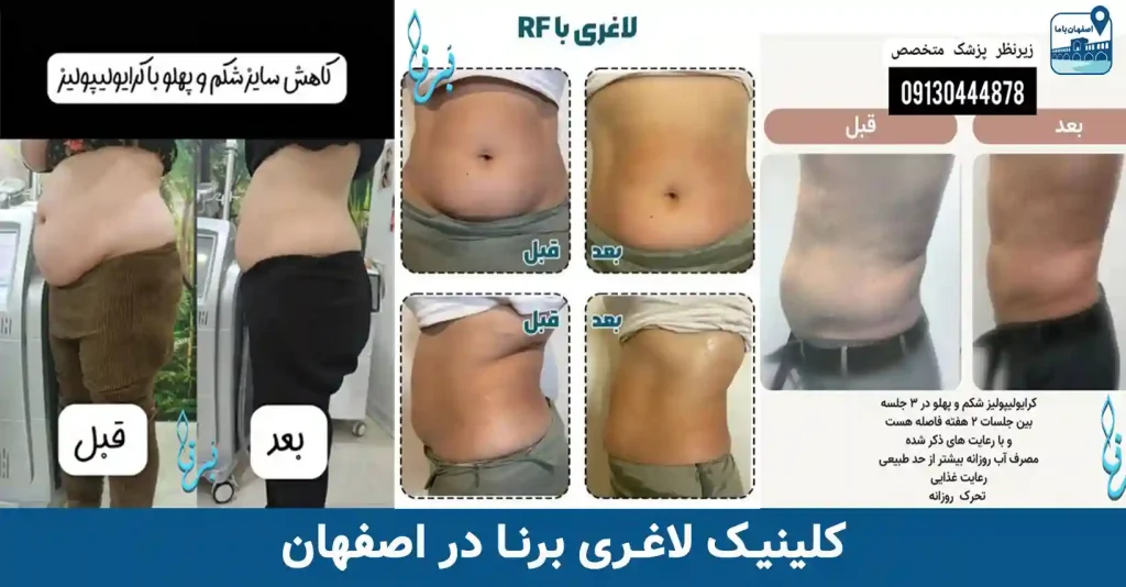 کلینیک لاغری برنا در اصفهان