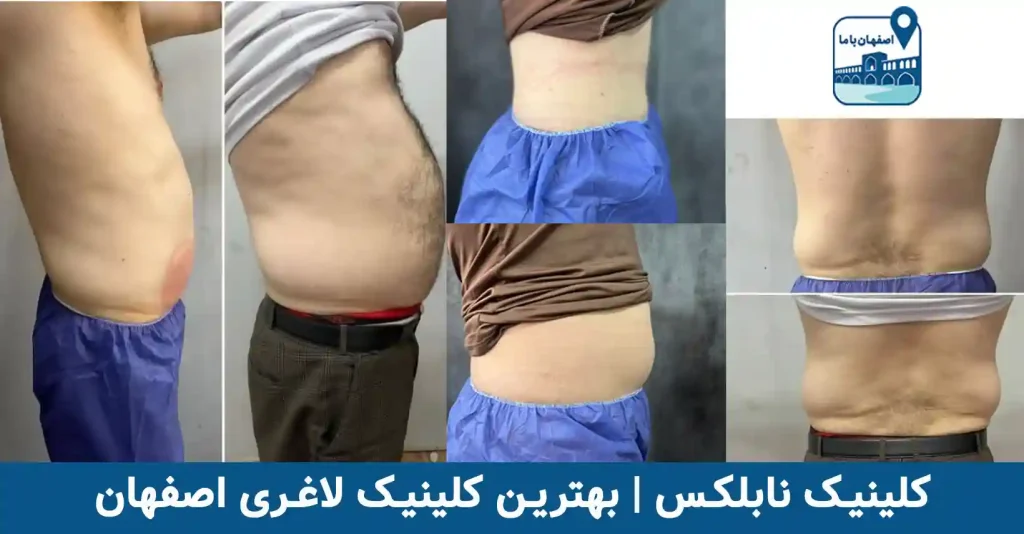 کلینیک لاغری نابلکس در اصفهان
