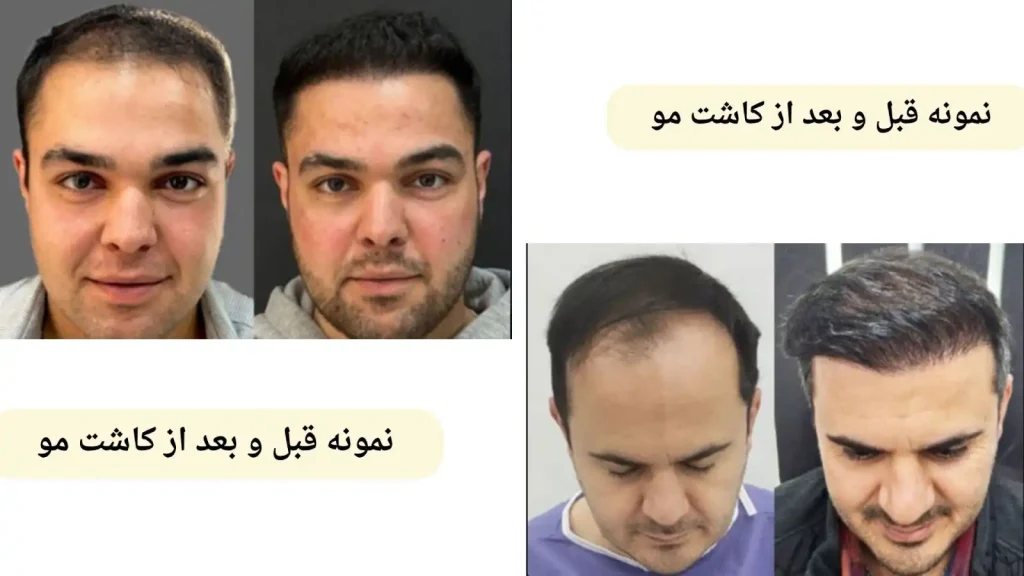نمونه قبل و بعد از کاشت مو