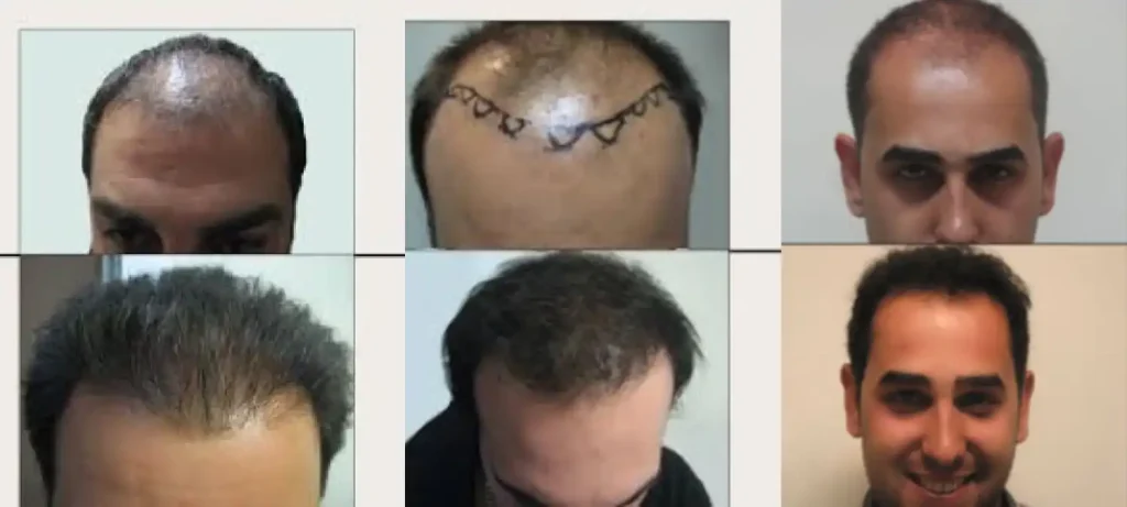نمونه کار قبل و بعد از کاشت مو دکتر مسلمی
