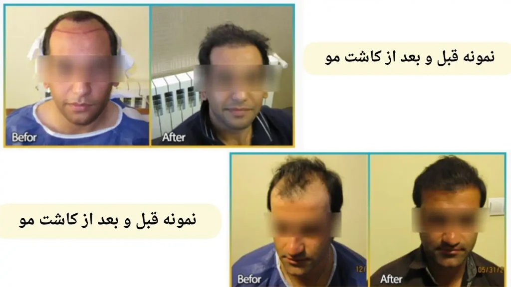 نمونه کاشت مو کلینیک آفتاب اصفهان