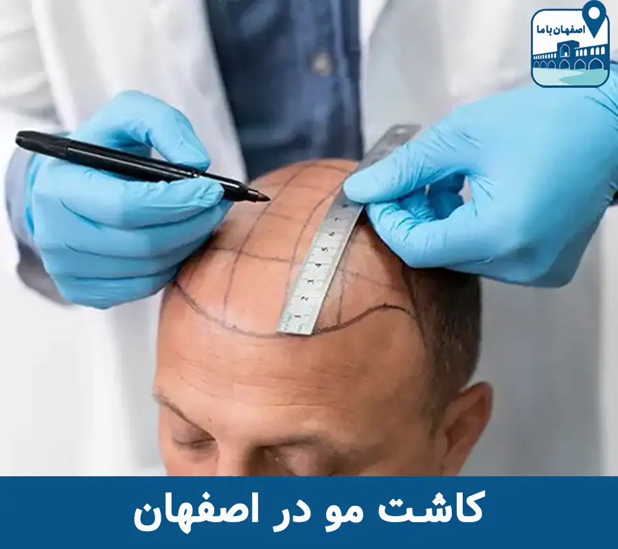کاشت مو در اصفهان