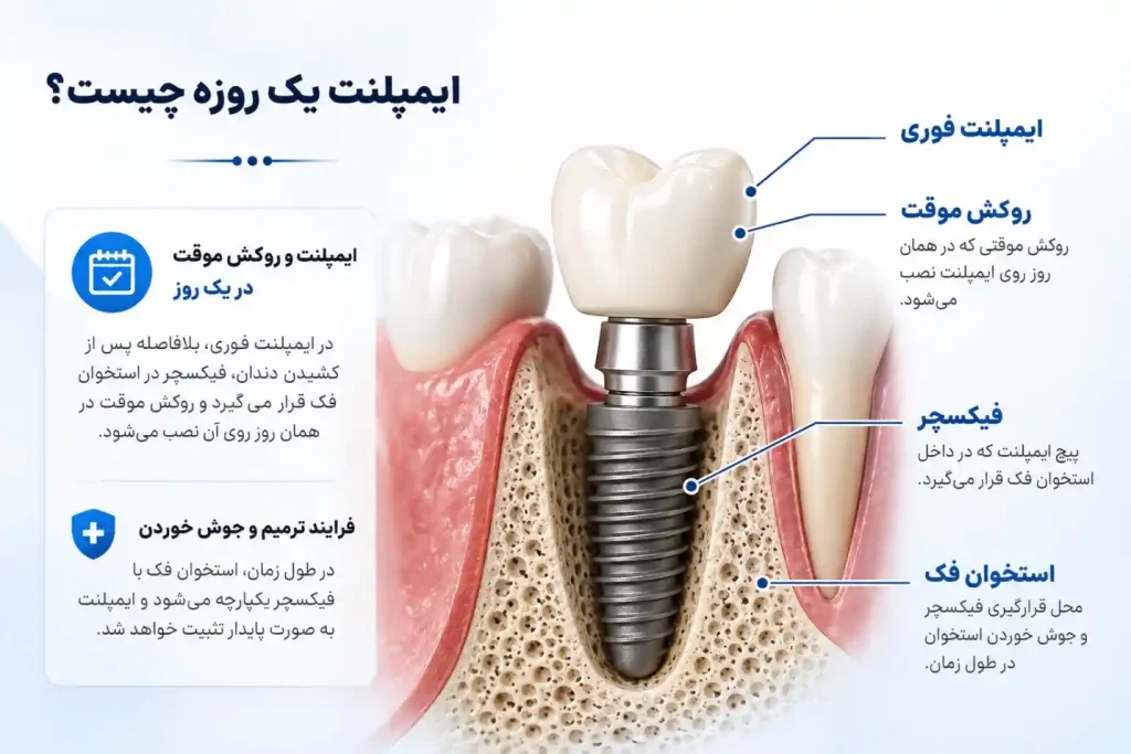 ایمپلنت یک روزه فوری در اصفهان