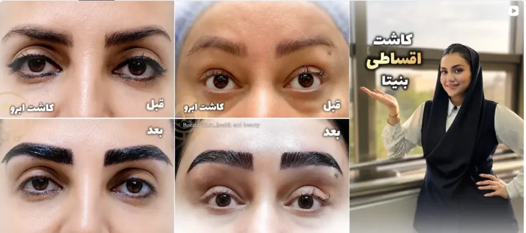 نمونه کاشت ابرو بنیتا