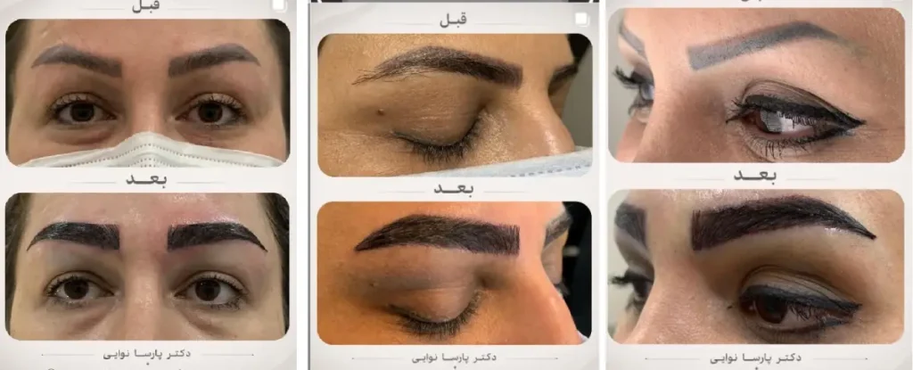 نمونه کاشت ابرو دکتر نوایی