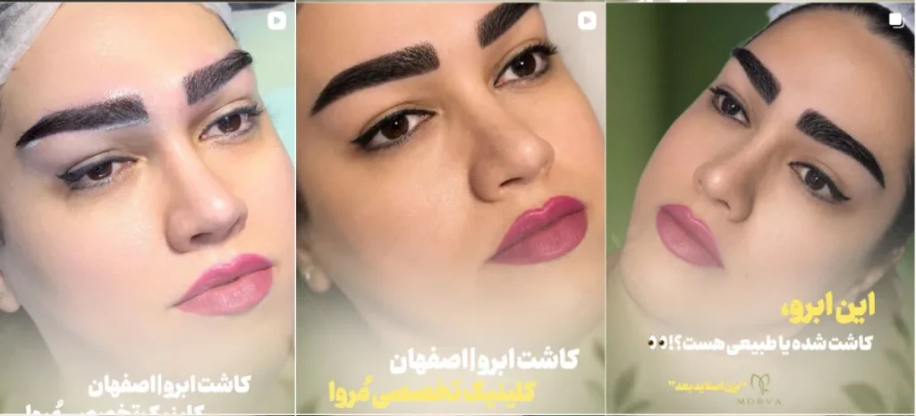 نمونه کاشت ابرو کلینیک مروا