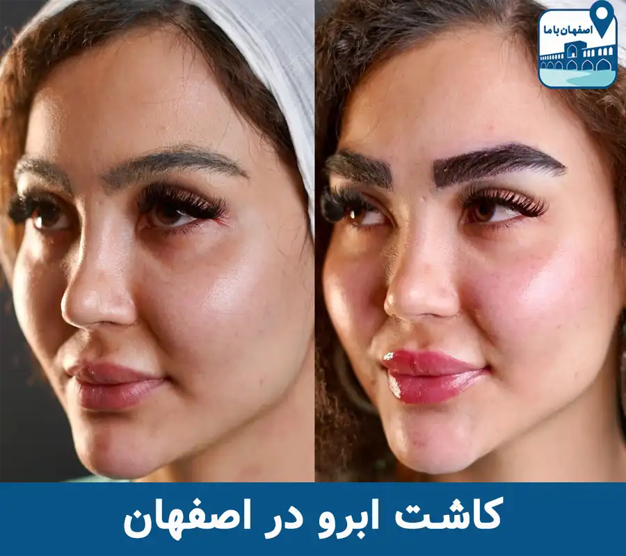 کاشت ابرو در اصفهان